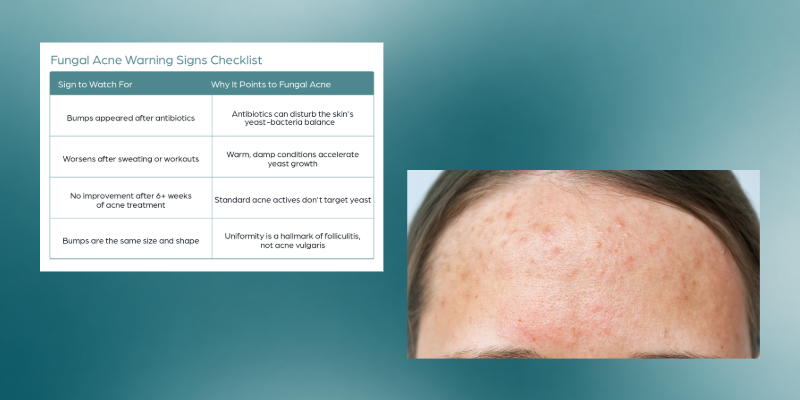 Fungal Acne: A Beginner's Guide to Spotting the Difference