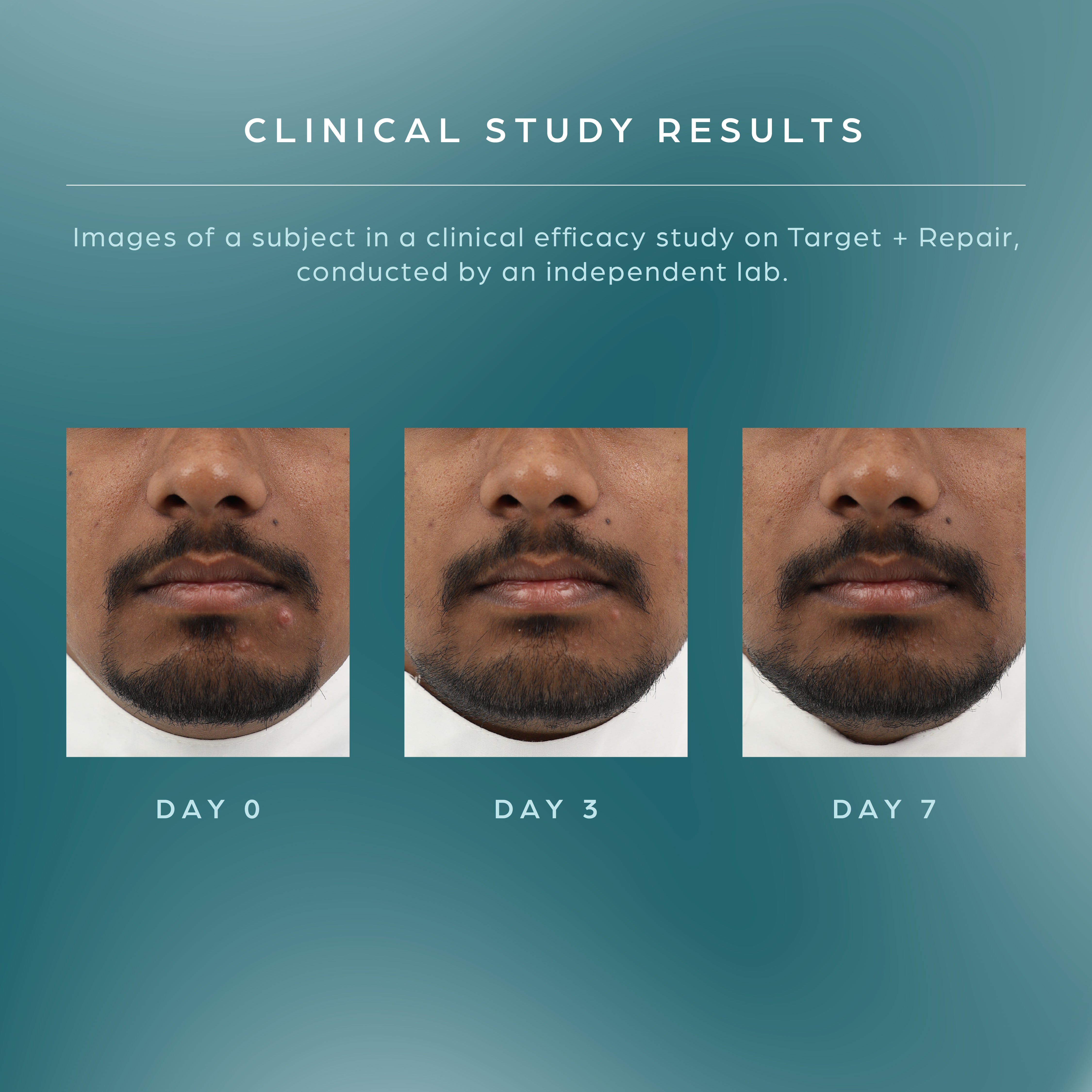 Target + Repair | Acne Spot Corrector