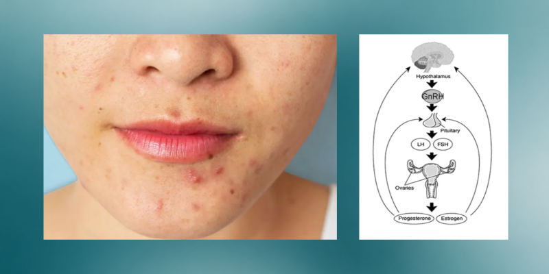 Period and hormonal acne