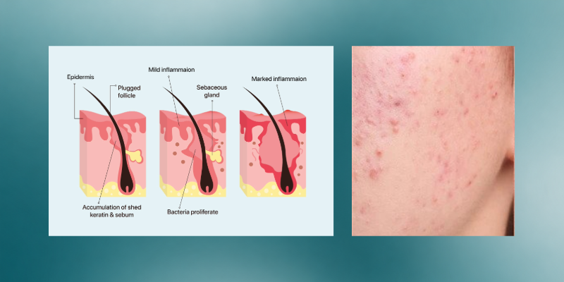 The Beginner's Guide to Skin Purging vs Breaking Out